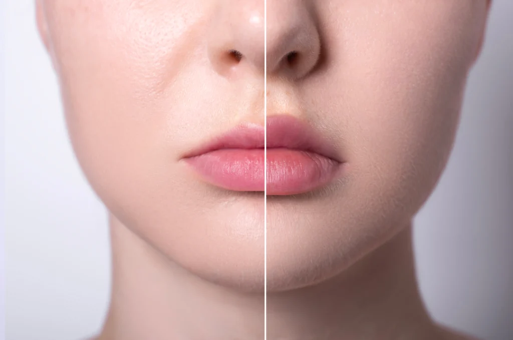 Side-by-side comparison of lips before and after a lip filler procedure.