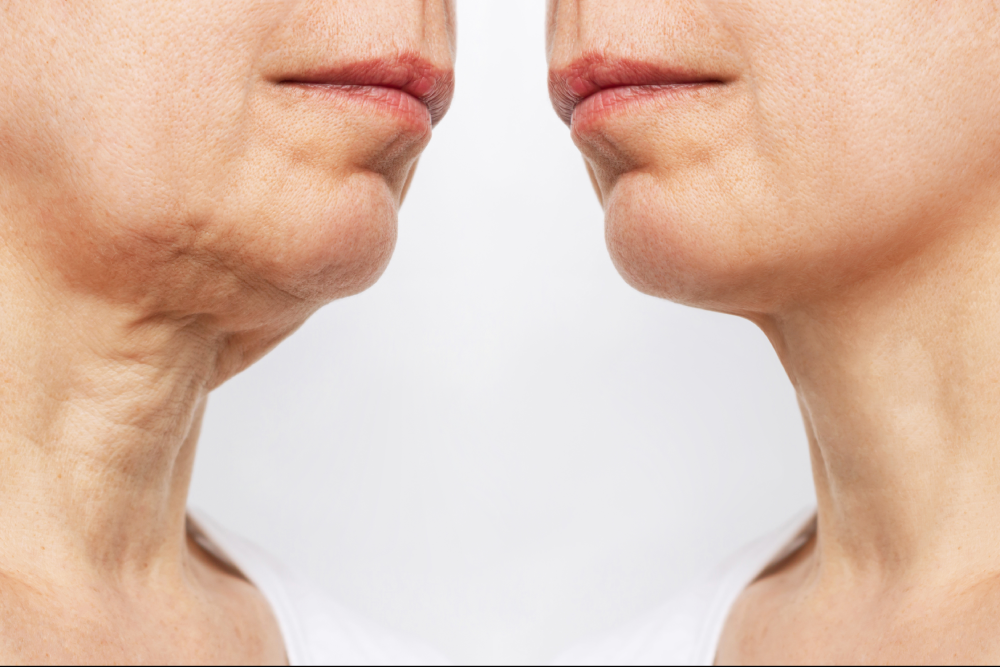 Before and after results of injectables on lower face.
